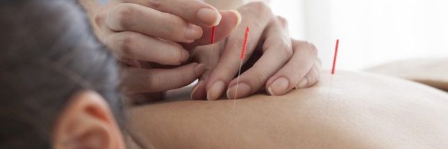 acupuncture treatment